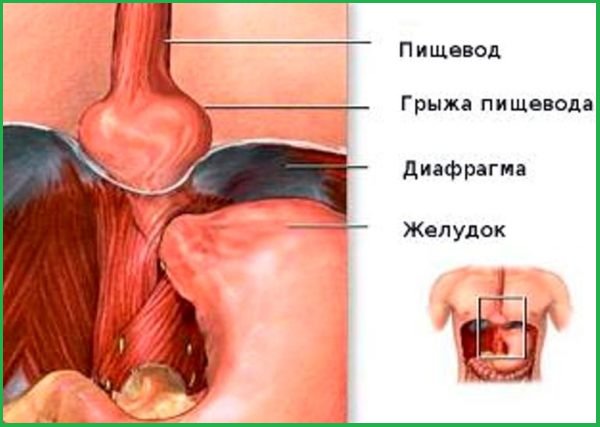 схема грыжи пищевода