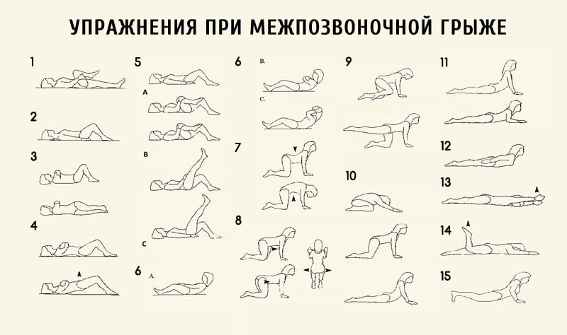 Гимностика при межпозвоночной грыже