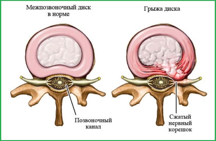 На рисунке показано два диска: здоровый и с грыжей.