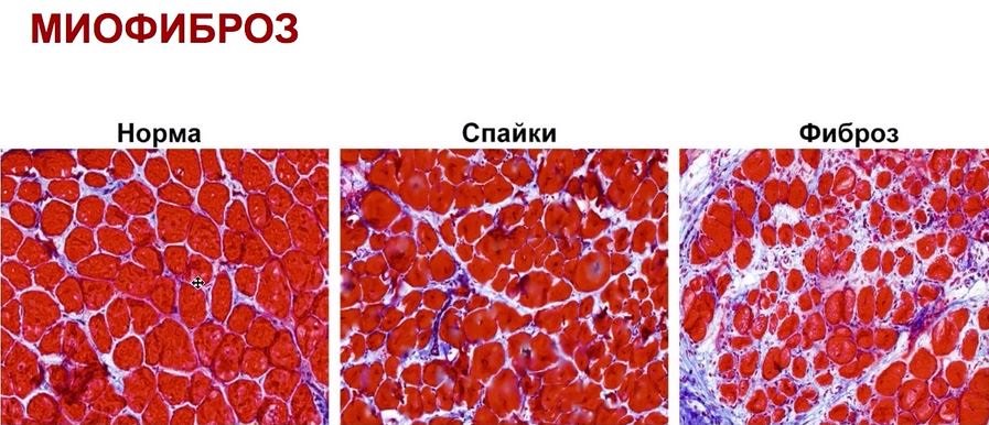 Миофиброз: норма и спайки.