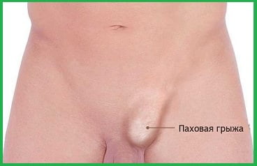 рисунок с паховой грыжей