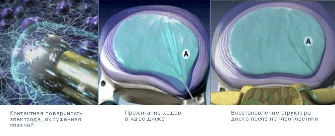 Последовательность действий при нуклеопластике.