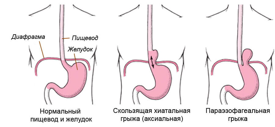 Рисунок с типами желудочной грыжи