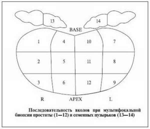 Точки мультифокальной биопсии