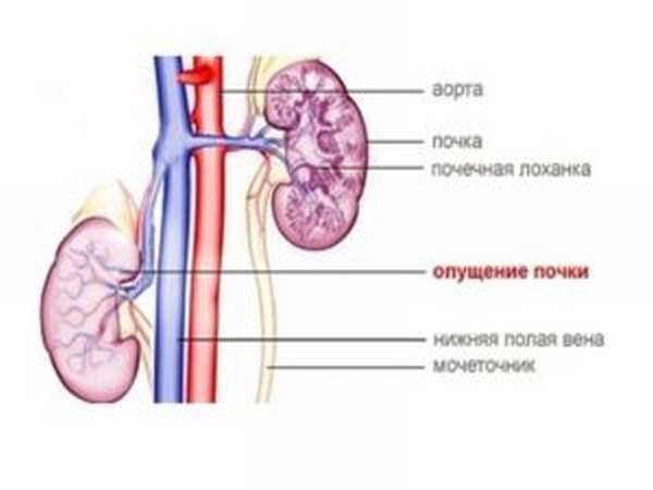 Опущение почки