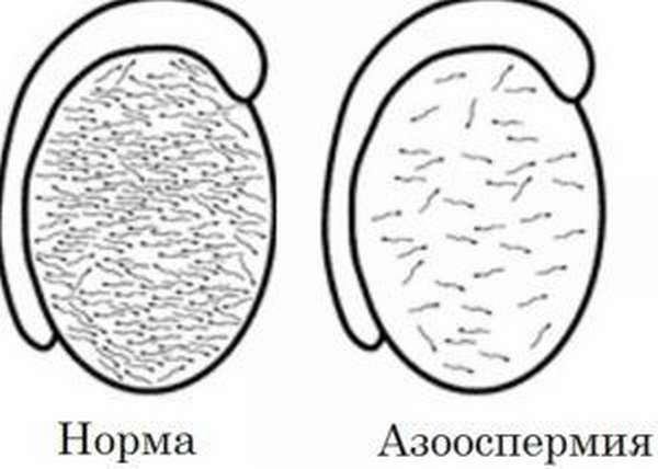 Азооспермия