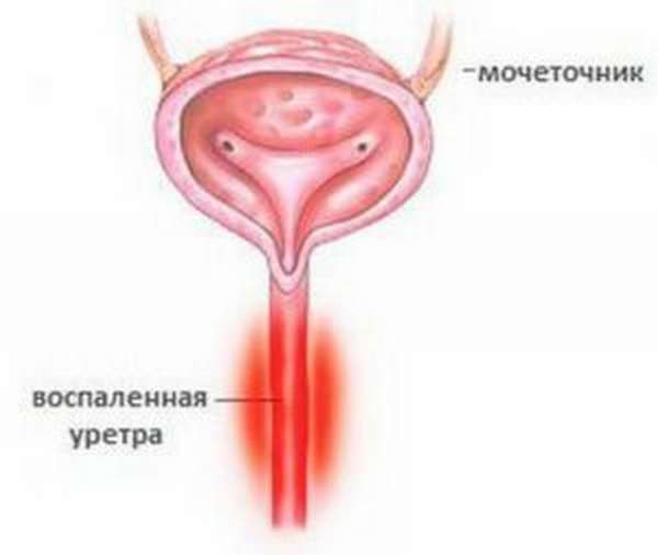 уретрит
