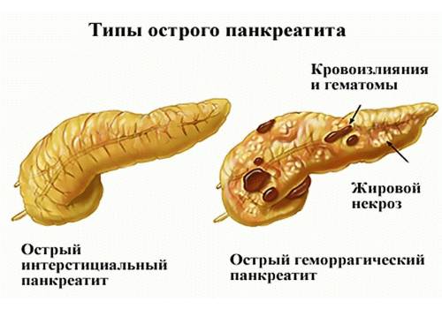 разновидности заболевания