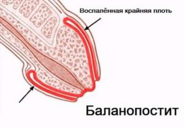 При баланопостите мужчина испытывает боль и дискомфорт, что затрудняет эрекцию