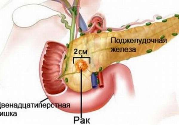 Рак головки ПЖ