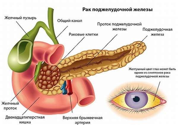 Пожелтение склер - признака рака ПЖ