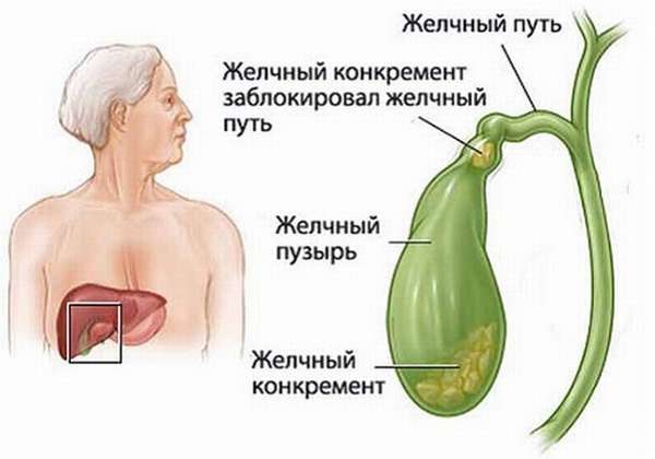 Камни в желчном пузыре