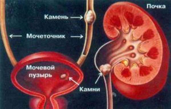 Профилактика мочекаменной болезни