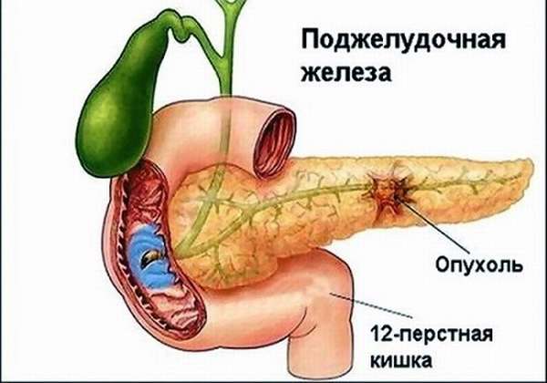Рак ПЖ