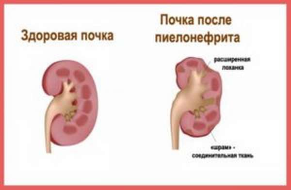 Пиелонефрит