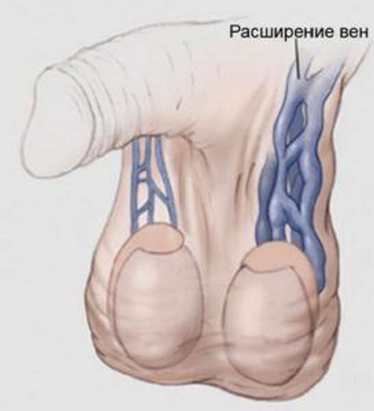 Варикоцеле