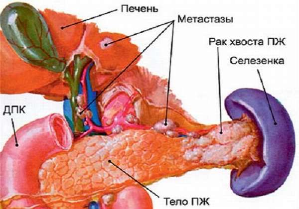 Рак хвоста ПЖ