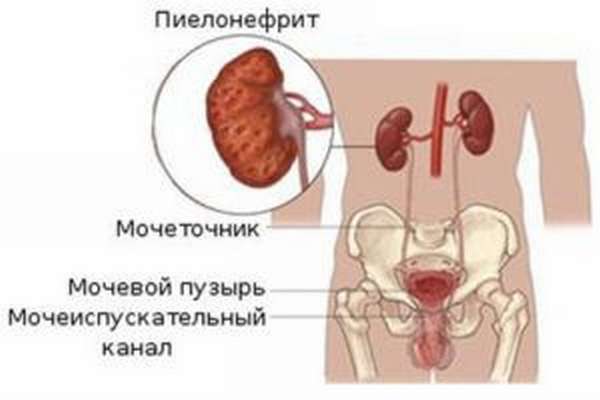пиелонефрит