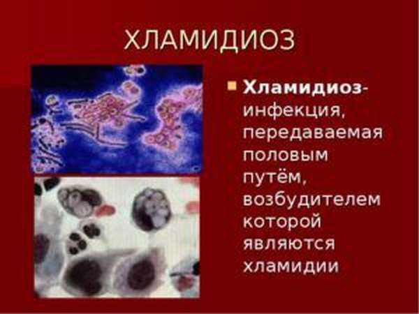 Хламидиоз