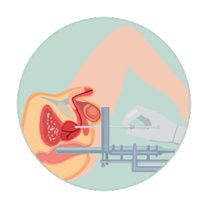 простатит